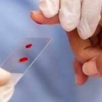 Estiman que más de 570 dominicanos viven con hemofilia