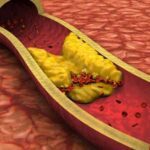 Señales sutiles que pueden alertar de enfermedades vasculares